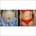 Tummy Tuck Surgery Manufacturer Supplier Wholesale Exporter Importer Buyer Trader Retailer in New Delhi Delhi India